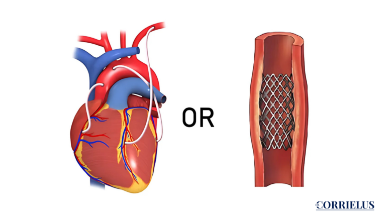 Angioplasty