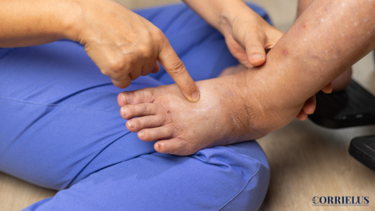 Understanding Leg Swelling And Its Links To Heart Failure